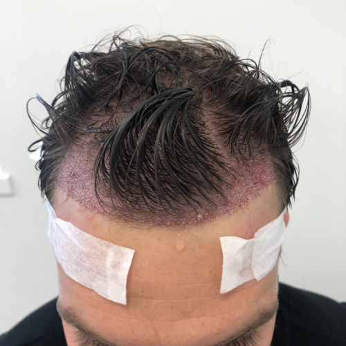 a-man-starting-his-one-week-after-a-hair-transplant-1024x1024
